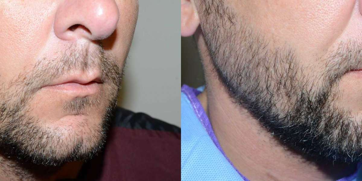 Facial Hair Transplant