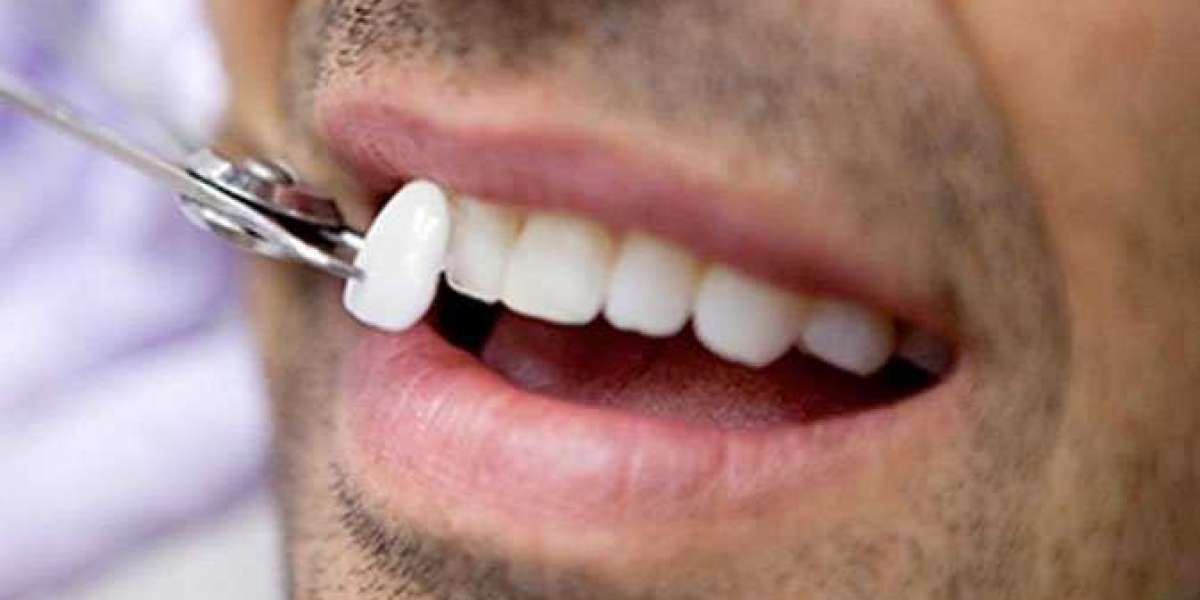 Dental Veneers - What You Should Know Before Opting For Dental Veneers