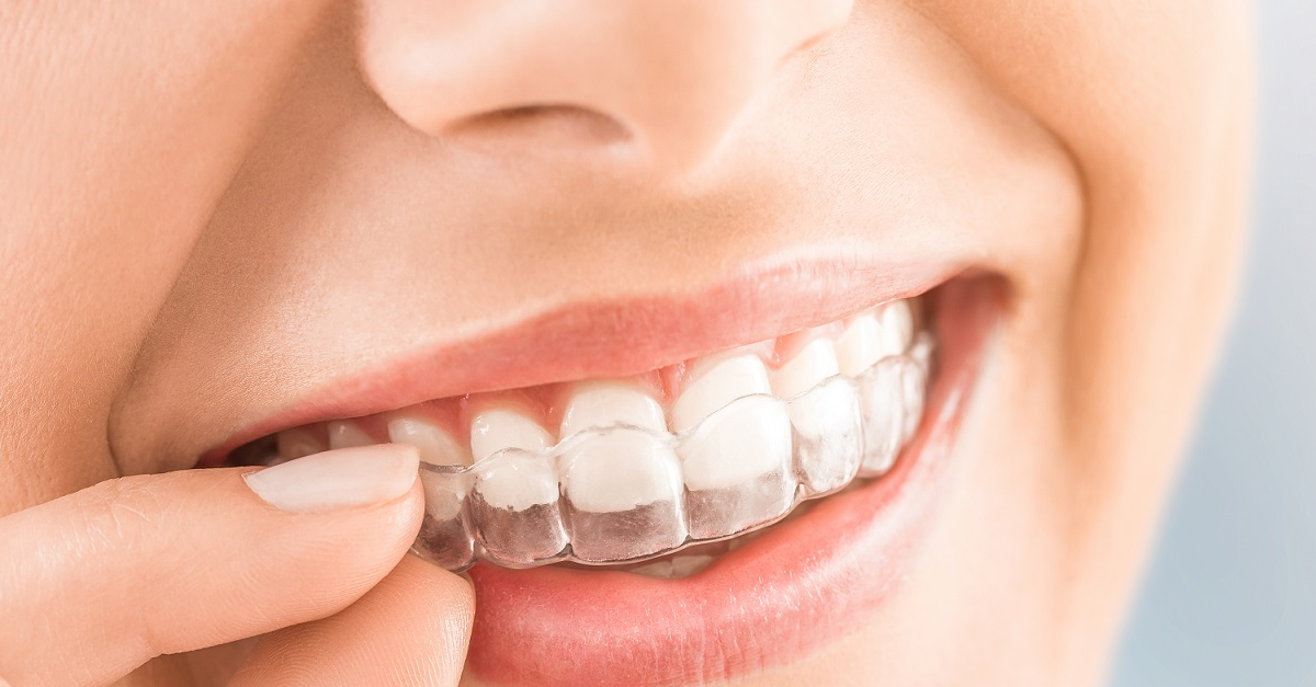 The Comprehensive Guide to Invisible Braces Cost