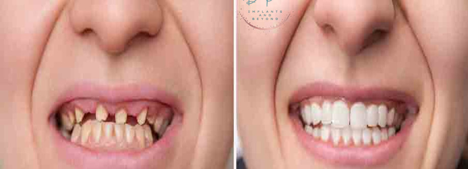 Dental Implants as Your Trusted Cover Image