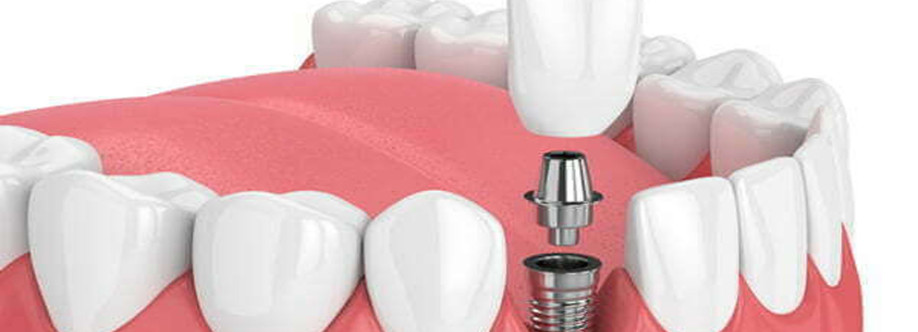 Science Behind Dental Implants Cover Image