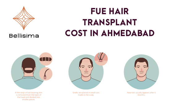 FUE Hair Transplant Cost Ahmedabad | FUE Hair Transplant Price