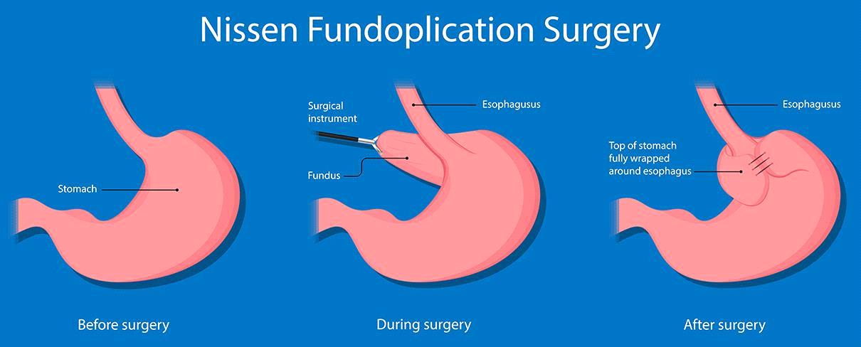 Reflux Surgery Dallas, Mansfield & Plano | Anti-Reflux Surgery Dallas, Fort Worth TX