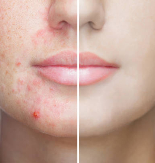 Acne Treatment in Ahmedabad | Sparsh Skin Clinic
