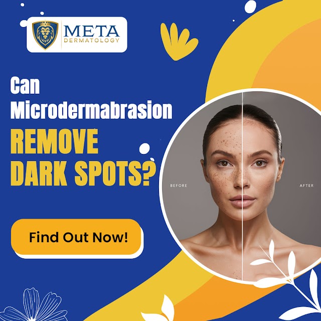 Can Microdermabrasion Remove Dark Spots? - Meta Dermatology