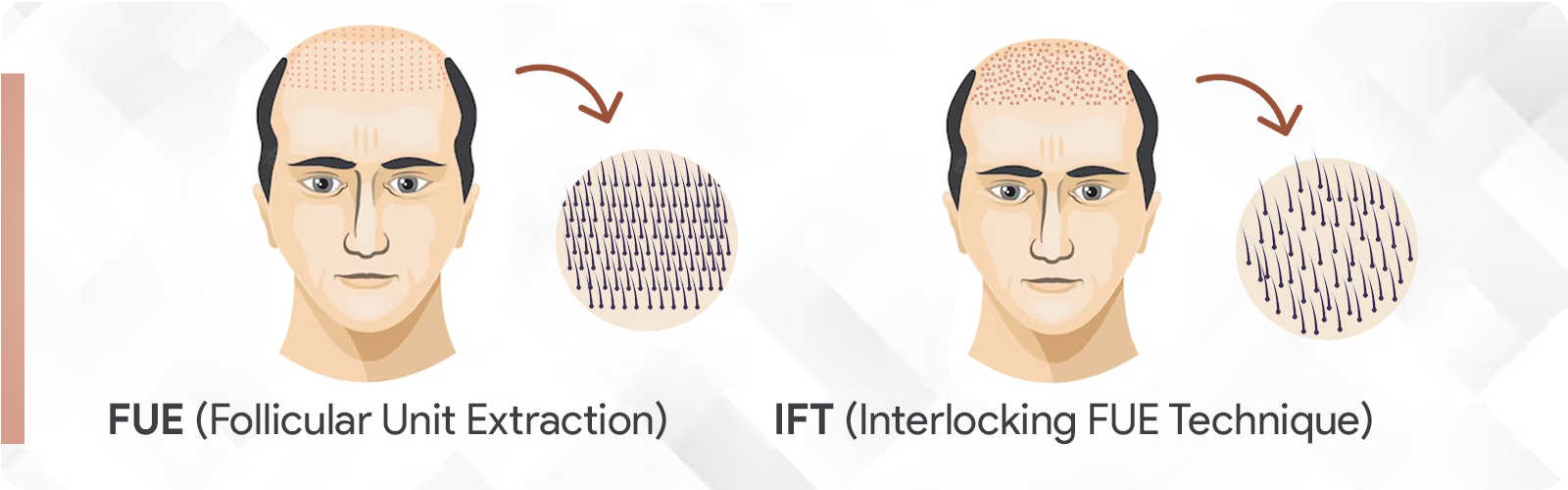 Hair Transplant in Jaipur | IFT Hair Science