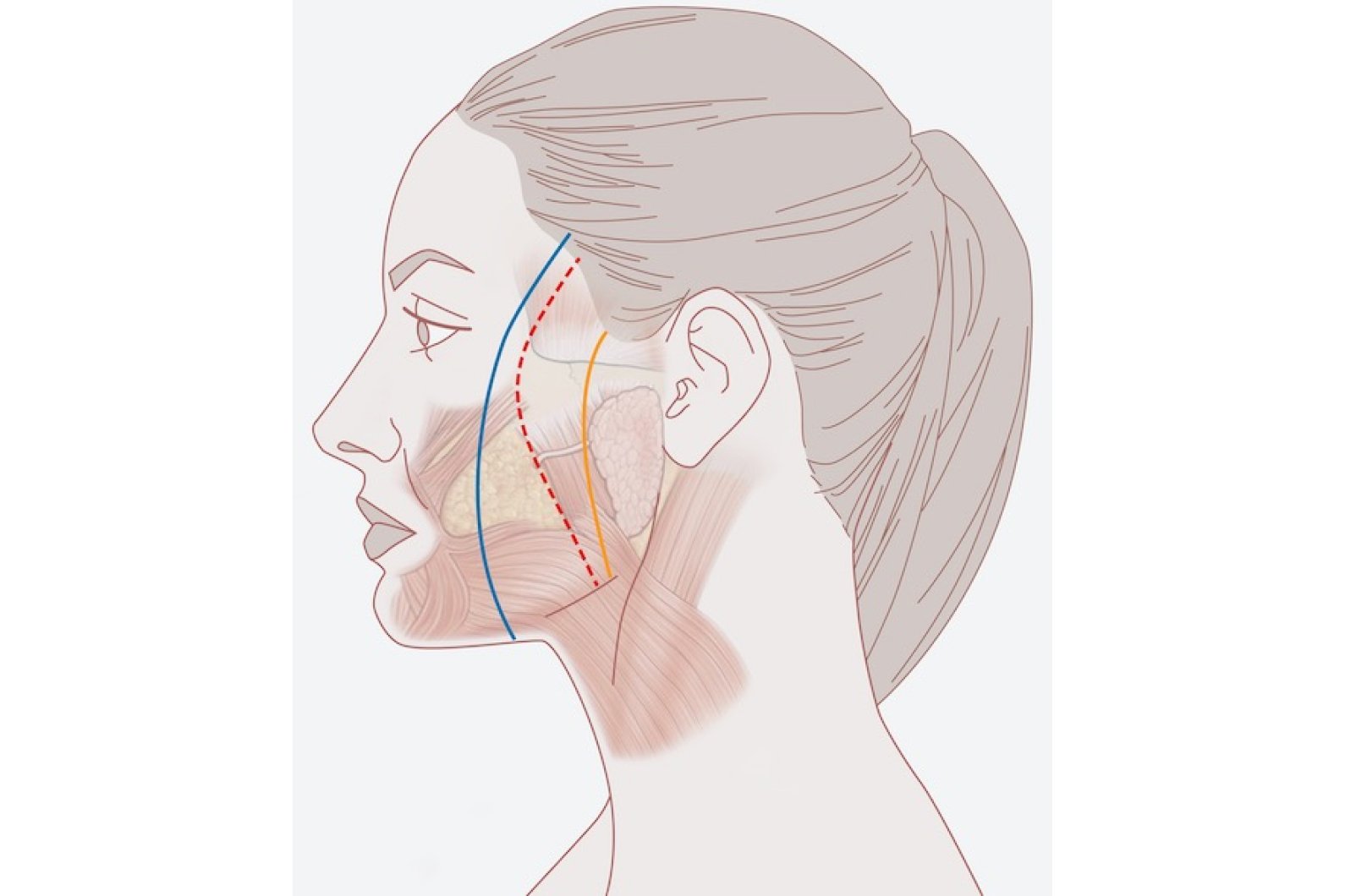 Best Facelift High SMAS Technique in Swiss by Dr Tremp