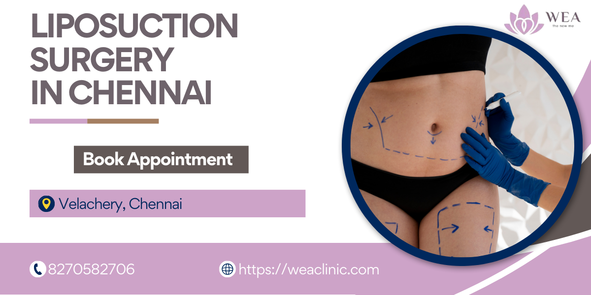 Best Liposuction Surgery in Chennai | Liposuction Velachery