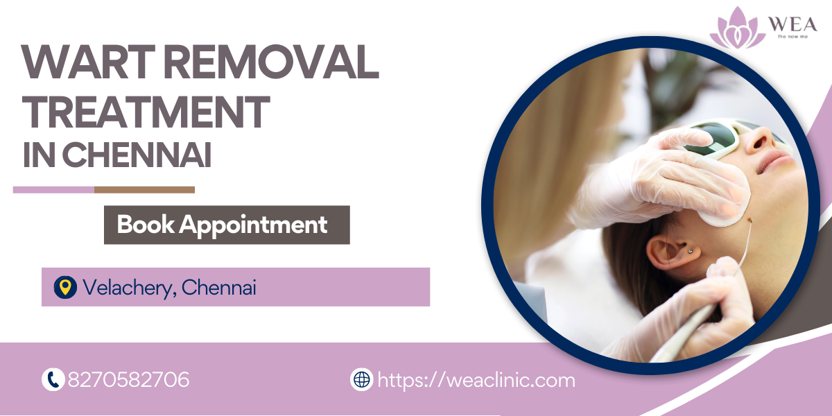 Wart Removal Treatment in Chennai | Wart Removal in Chennai