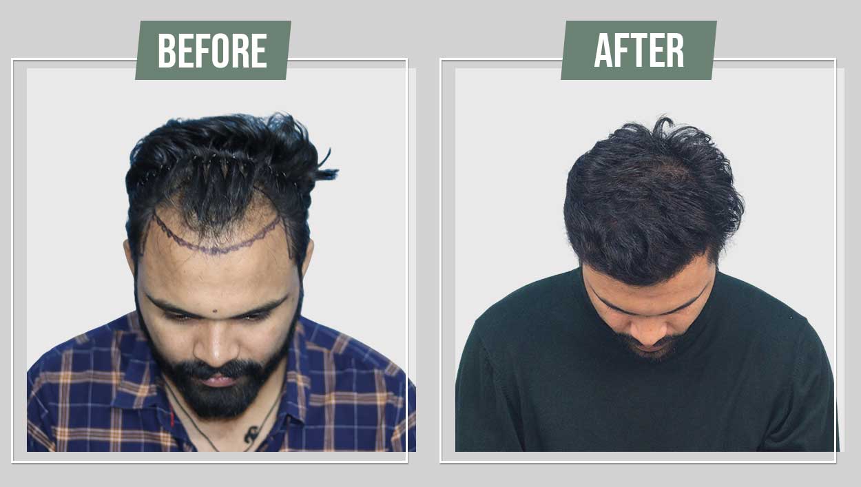 Hair Transplant in Jaipur | Best Hair Transplant Clinic in Jaipur